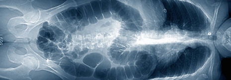 Darmkrebs-Rückfälle mit ctDNA früher nachweisbar als im CT