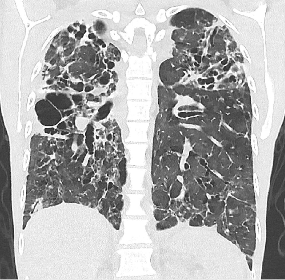 Variables Immundefektsyndrom mit rezidivierenden Pneumonien und zunehmender Fibrose der Lunge.