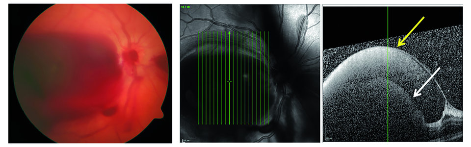 Funduskopisch fand sich eine randunscharfe und geschwollene Papille mit Randblutung. In der Kohärenztomographie fielen die subhyaloidale (gelber Pfeil) und die Sub-ILM-Blutung (weißer Pfeil) auf.