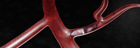 Je aktiver die Arthritis, desto mehr Thromboembolien