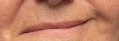 Fazialis durch Impfung kaum gefährdet