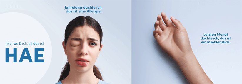 Bei hereditärem Angioödem individuell angepasst behandeln