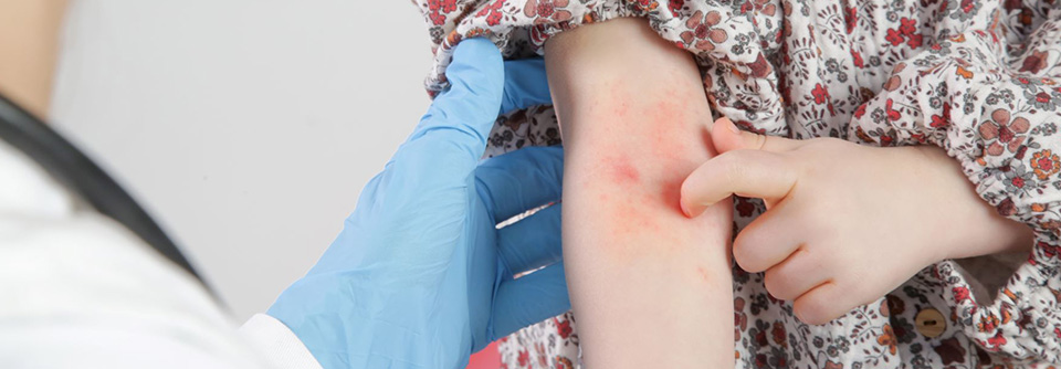 Atopische Dermatitis: Frühzeitig handeln, um Komorbiditäten vorzubeugen