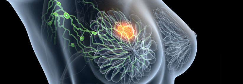 Das Lymphsystem nimmt im Rahmen einer Brustkrebsbehandlung häufig schaden.