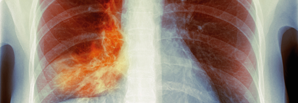 Dieses Bild zeigt eindeutig eine Lobärpneumonie. Kleinere Infiltrate können dem Nachweis im Röntgen aber entgehen.