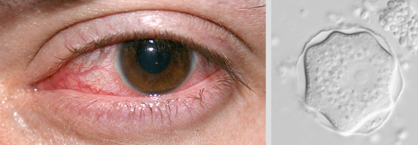 Akanthamöben fängt man sich beim Schwimmen oder Duschen mit Kontaktlinsen ein. Die Therapie dauert mehrere Monate.