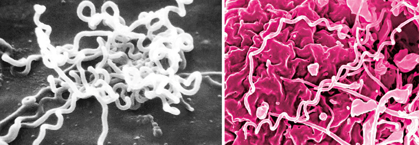 Eine Infektion mit Treponema pallidum kann zur Hepatitis führen.