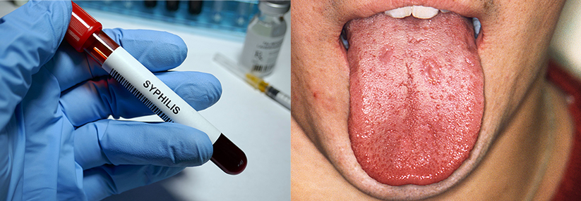 Rechtes Bild: Schleimhautveränderungen im Mund eines Patienten zu Beginn des Sekundärstadiums der Syphilis.