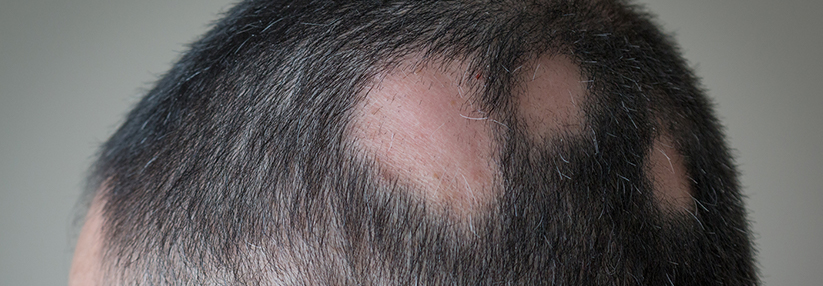 Bei Alopecia areata kommt es zu Haarausfall, häufig am Kopf, vereinzelt aber auch an anderen Körperstellen.