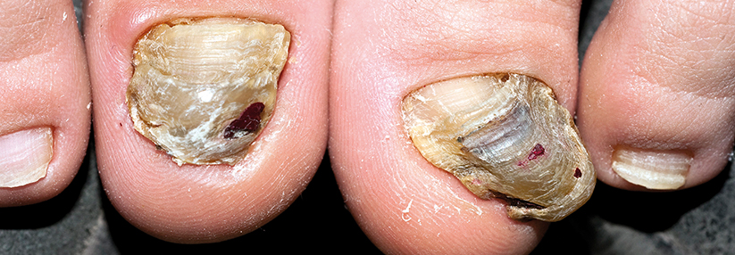 Schlucken und lackieren – Schweren Nagelpilz mit Kombitherapie behandeln Haben sich die Nägel bereits krallenartig verändert, spricht man von einer Onychogrypose.
