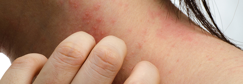 In Phase-2-Studien an Patienten atopischer Dermatitis linderte der Wirkstoff den Juckreiz. (Agenturfoto)