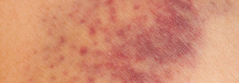 Eine Gerinnungsstörung, Vaskulitis oder ein Lupus erythematodes – die Liste potenzieller Auslöser druckschmerzhafter Hautveränderungen lässt sich beliebig fortführen. 