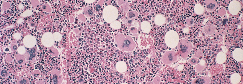 Durch die Myelofibrose kann das Knochenmark keine Blutzellen mehr produzieren. In diesen Fällen übernimmt die Milz.