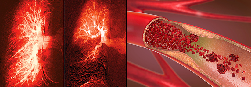 Bei einer Lungenembolie kommt es insbesondere auf die Wahl des am besten geeigneten Antikoagulans und das Festlegen der Behandlungsdauer an.