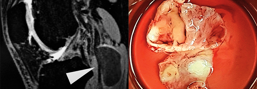 Abb. 1: Woher kommen Schmerz und tastbare Resistenz in der Kniekehle? Die MRT zeigt die Ursache, ein sacciformes Aneurysma der Poplitealarterie (ø 4,2 cm) ohne thrombotische
Auflagerungen. Abb. 2: Resezierter Aneurysmasack eines rechtsseitigen PAA.