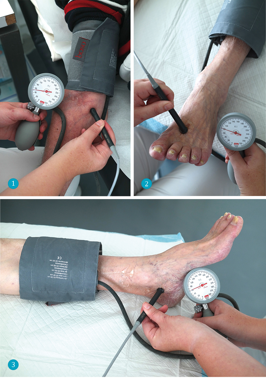 Um den Knöchel-Arm-Index zu berechnen, erfolgt die Doppler-Druckmessung der Aa. brachialis (1), dorsalis pedis (2) und tibialis posterior (3). Gebildet wird jeweils der Quotient aus Fuß- und Armarteriendruck.