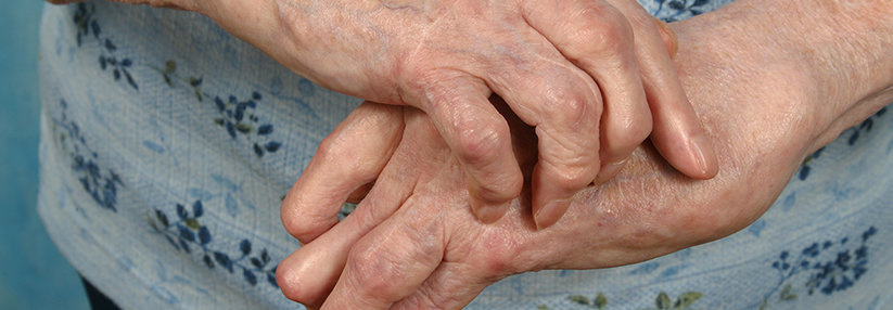 Auch wenn die Patienten nur noch einzelne geschwollene Gelenke aufweisen, sollte man immer prüfen, ob die Basistherapie vielleicht doch intensiviert werden muss.