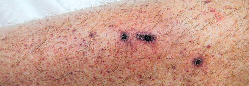 Schritt-für-Schritt-Anleitung zur Ursachenfindung der Thrombozytopenie Petechien, vor allem an den Beinen, sind ein typisches klinisches Zeichen für eine Thrombozytopenie.