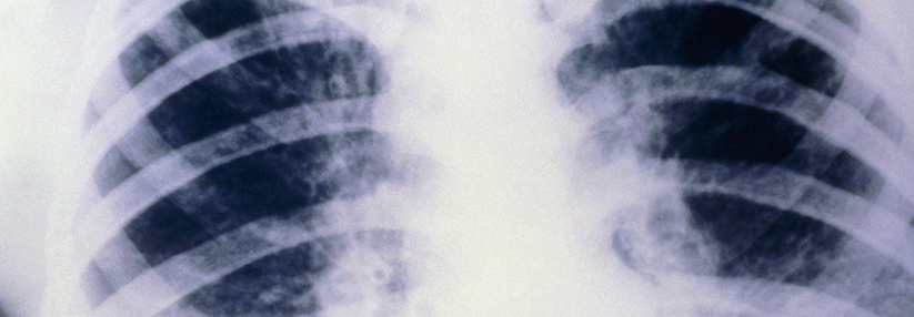 Mukoviszidose: Von Kombinations- und Gentherapien bis hin zu neuen Antiinfektiva