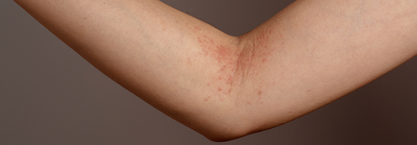 Neurodermitis: Mit Vitamin D die Basistherapie unterstützen