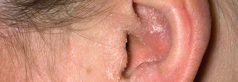 Otitis externa: Diagnose mit Stimmgabeltest nach Weber sichern