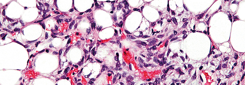 Polymyalgien bei älteren Patienten: Rheuma oder Tumorerkrankung?