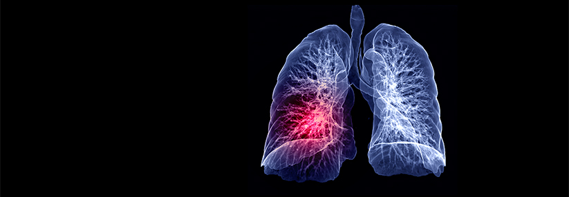 Stand die Diagnose früher ab einem mittleren arteriellen Blutdruck in der Pulmonalarterie von 25 mmHg in Ruhe fest, wurde dieser Grenzwert nun auf 21 mmHg abgesenkt.