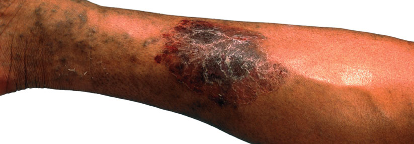 Krampfadern behandeln: Kompressionstherapie und invasive Verfahren Purpura jaune d‘ocre am Schienbein und Corona phlebectatica paraplantaris: Dieses Bild entspricht Klasse C4.