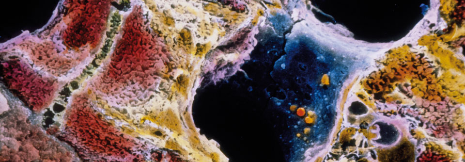 Zirrhotisches Leberläppchen unterm Elektronenmikroskop. In das geschädigte Gewebe wandern Phagozyten (gelb). Blutgefäße: blau, Hepatozyten: dunkelbraun.