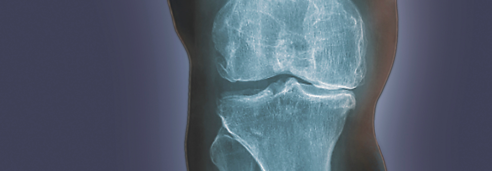 Gonarthrose – Was tun, wenn’s im Knie knirscht? Überlastetes Knie einer übergewichtigen Frau. Schon mit 48 Jahren leidet sie unter einer Gonarthrose.