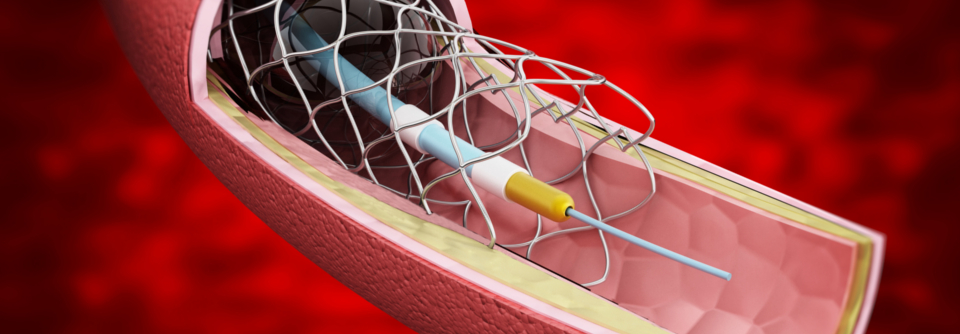 Zur dualen Plättchenhemmung nach perkutaner Koronarintervention (PCI) wird neben ASS meist Clopidogrel verordnet.