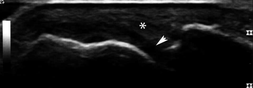 Kleiner Erguss (Pfeil) und Pannus (Sternchen) im zweiten Metacarpal-Phalangealgelenk als Zeichen einer aktiven Synovitis.