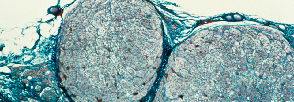 Benigne, aber problematisch: Diese Adenome bildeten Kortisol im Übermaß. Der Patient litt unter einem Cushing-Syndrom.