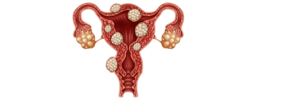 Jede vierte von einem Utersmyom Betroffene leidet unter Schmerzen oder starken Menstruationsblutungen, die nicht selten zu einer Anämie führen. 