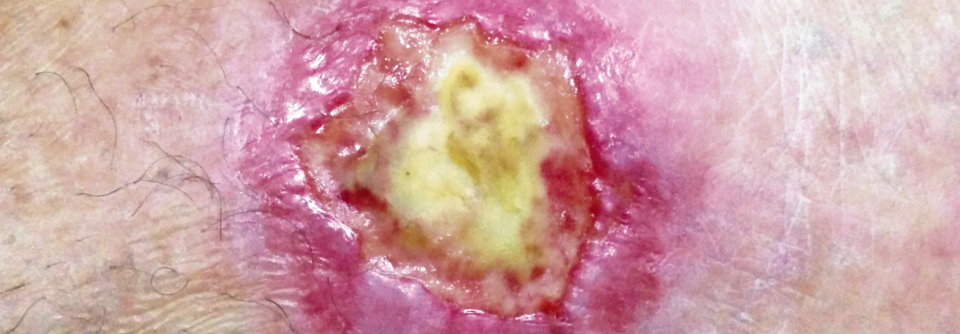 Diagnose und Behandlung der Livedovaskulopathie