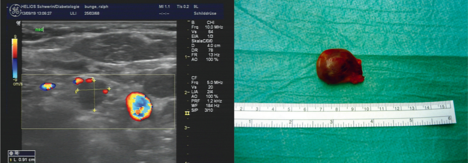Sonographischer Befund (links) nach der Resektion des singulären, etwa 3 cm großen 
Adenoms (rechts).