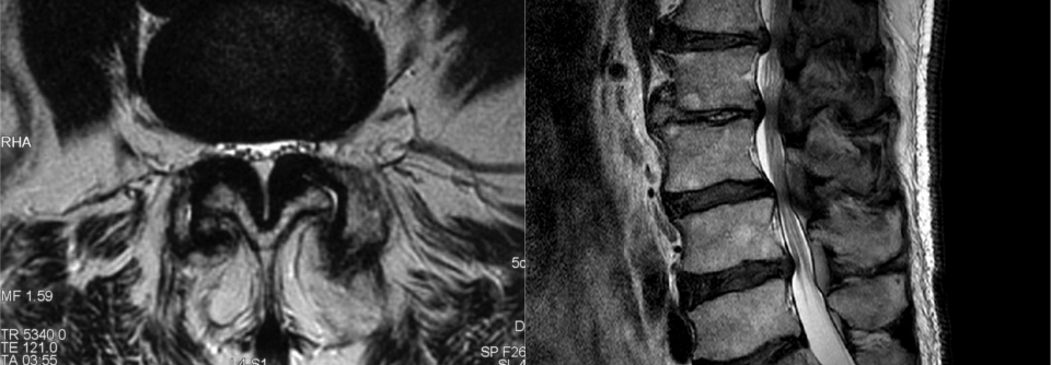 Spinalkanalstenosen entstehen bei Älteren vorwiegend als Folge von Spondylarthrose und Hypertrophie der Ligamenta flava.