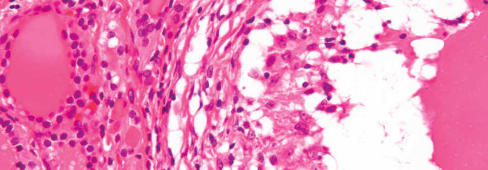 Eine Thyreoiditis tritt laut dem US-amerikanischen National Institute of Health bei 8 % der frischgebackenen Mütter auf.