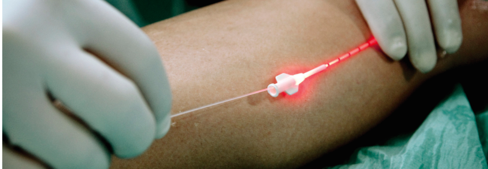Als Alternative zum Venenstripping kommen weniger invasive Verfahren mit Laser oder Schaum infrage.
