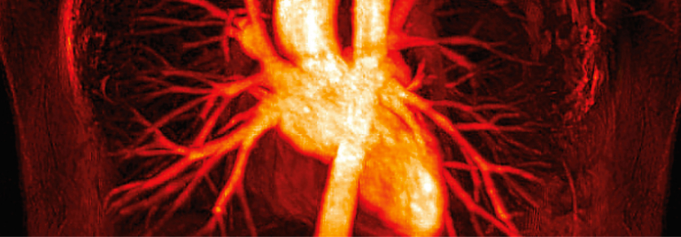Thoracic-Outlet-Syndrom: Diagnose und Behandlung im Überblick