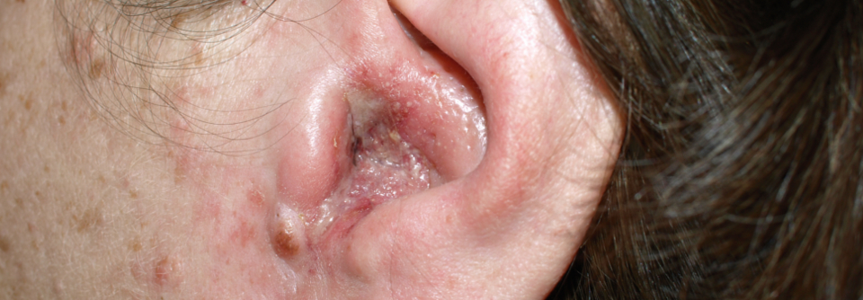 Otitis externa mit Schwellung des Gehörganges und Übergriff auf die Ohrmuschel.