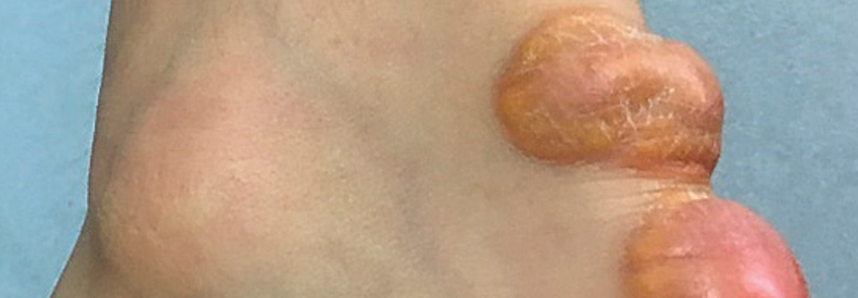 Bei der familiären Hypercholesterinämie ist frühes Handeln gefragt