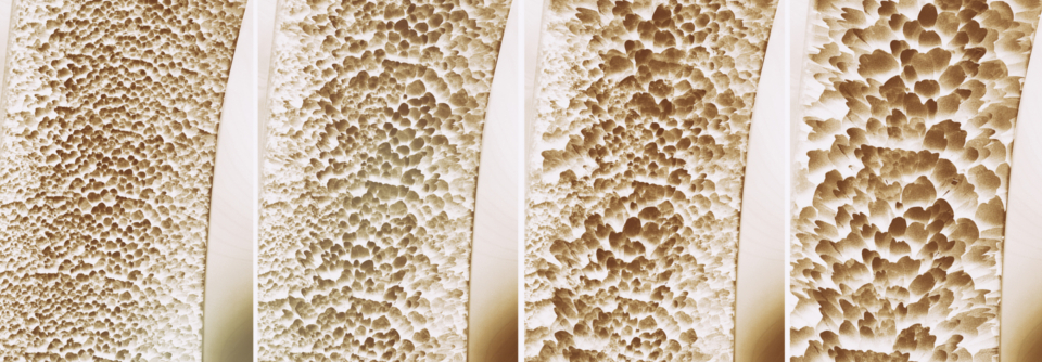 In der Behandlung der Osteoporose unterscheidet man zwischen antiresorptiv (Knochenabbau hemmend) und osteoanabol, (Knochenaufbau fördern).