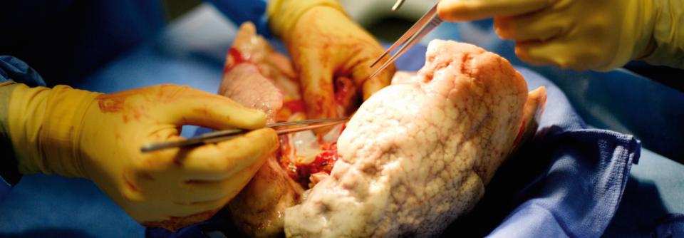COVID-19: Erfolgreiche Lungentransplantation bei schweren Verläufen
