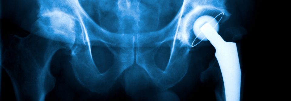 In fortgeschrittenen Stadien der Koxarthrose stellt sich die Frage, ob und wann genau die Implantation einer Hüft-Totalendoprothese sinnvoll ist.