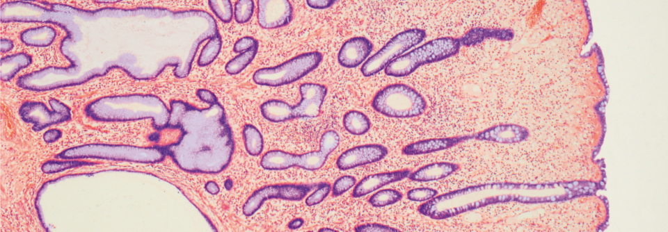 Juveniles Polyposis-Syndrom.