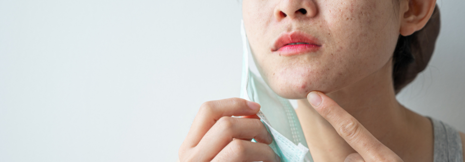 Pickel durch Maske – Mund-Nasen-Schutz kann zu Hautreizungen führen Auch Akne kann durch den Mund- und Nasenschutz getriggert oder verschlimmert werden.