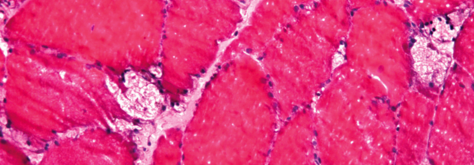 Im histologischen Bild zeigt sich beim M. Pompe eine vakuoläre Myopathie.