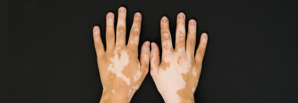 Klinisch äußert sich die Vitiligo als helle, scharf begrenzte symptomlose Flecken, die je nach Subtyp der Erkrankung Haut und Schleimhäute in unterschiedlichem Ausmaß befallen.
