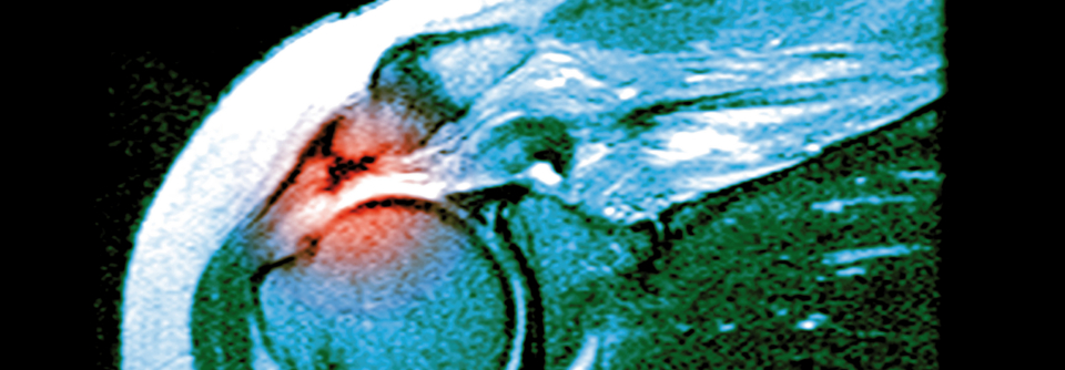 Viele Läsionen der Rotatorenmanschette lassen sich konservativ behandeln Die Manschette ist schon länger gerissen, der M. supraspinatus atrophiert und retrahiert.